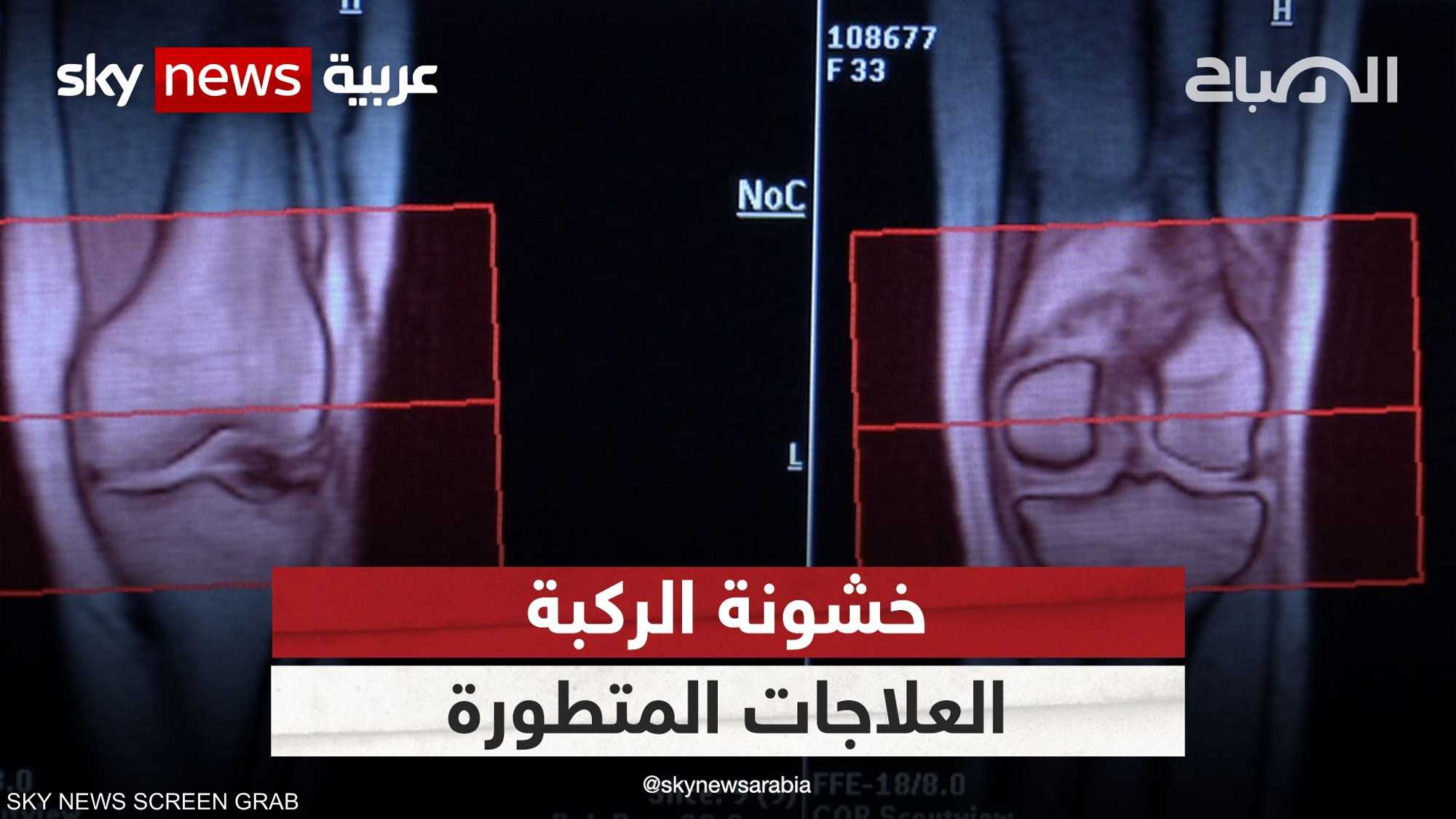 ما هي خشونة الركبة؟.. وهل يمكن للروبوتات إجراء جراحاتها؟