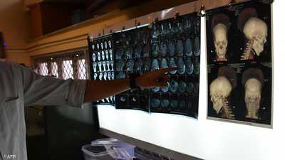 دراسات تكشف علاقة "مقلقة" بين الاكتئاب والصرع